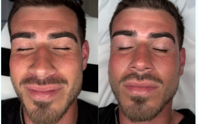 Real SlimFit HydraFacial patient — before