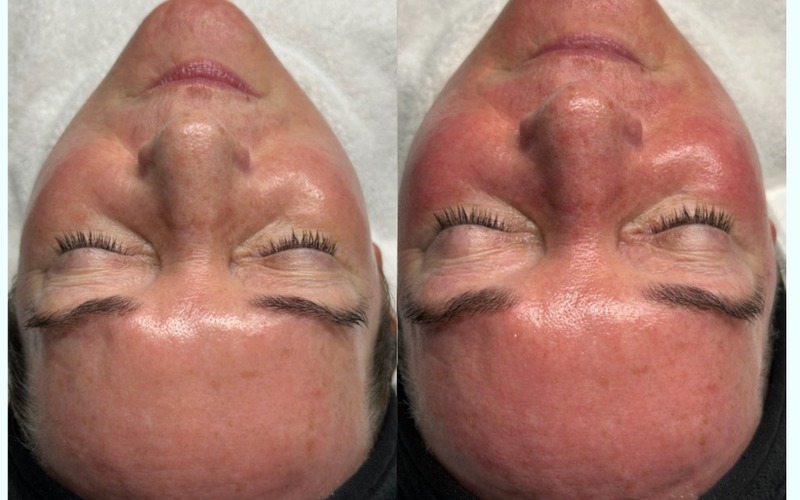 Real SlimFit HydraFacial patient — before and after