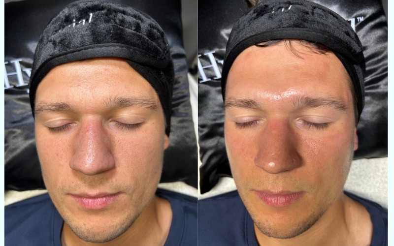 Real SlimFit HydraFacial patient — after six sessions
