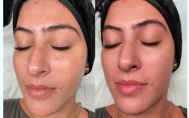 Real SlimFit HydraFacial patient — before and after
